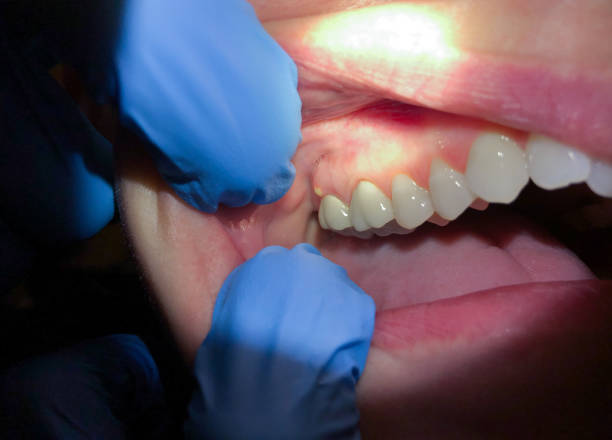Best Emergency Dentist for Knocked-Out Tooth in Copperopolis, CA