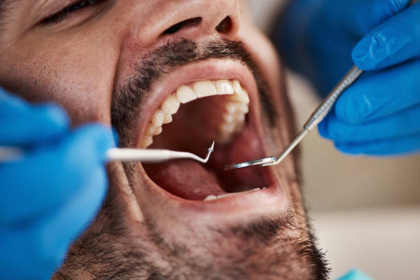 Best Emergency Dentist for Lost Fillings or Crowns in Copperopolis, CA
